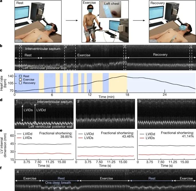 ?徐升重磅Nature：可穿戴+超聲成像，給你的心臟全方位實(shí)時(shí)監(jiān)測(cè)！